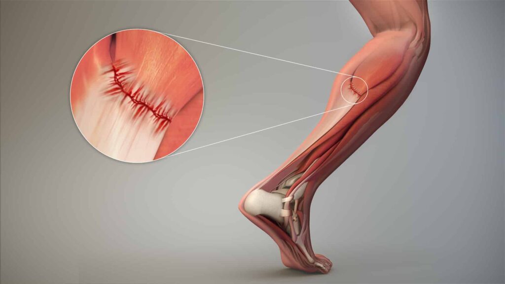 Che cosa significa lesione muscolare?