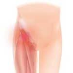 Che cosa significa groin pain?